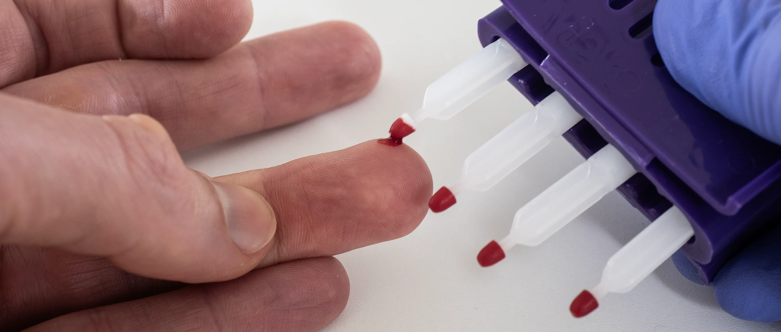 A capillary blood sample being collected onto a Mitra microsampling tip from a fingertip